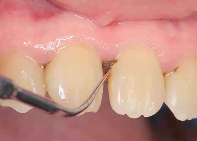 プラーク・歯石の除去