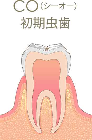 CO（シーオー）初期虫歯