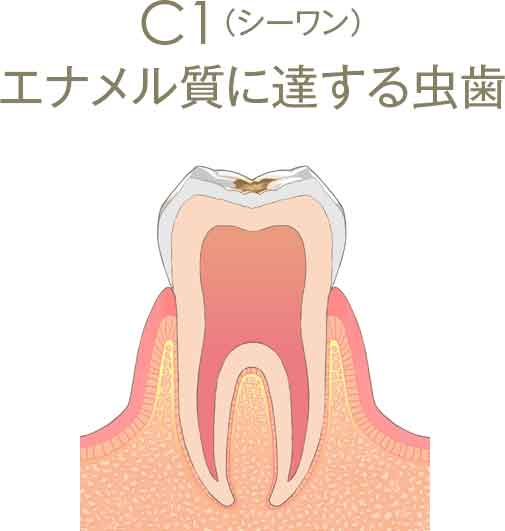 C1（シーワン）エナメル質に達する虫歯