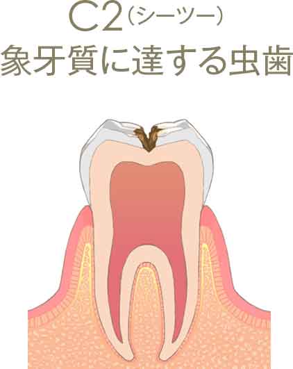 C2（シーツー）象牙質に達する虫歯