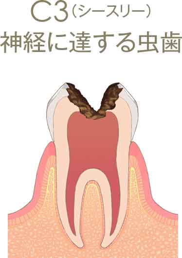 C3（シースリー）神経に達する虫歯