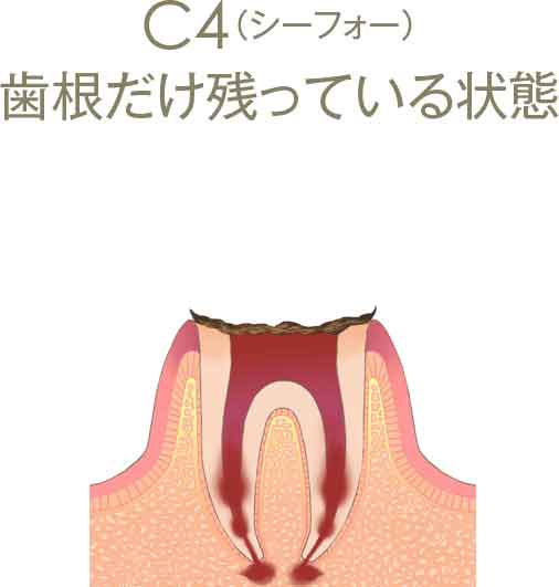 C4（シーフォー）歯根だけ残っている状態