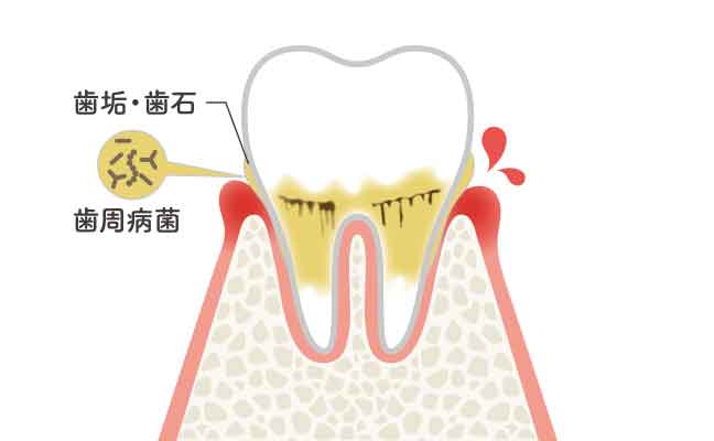 歯肉炎