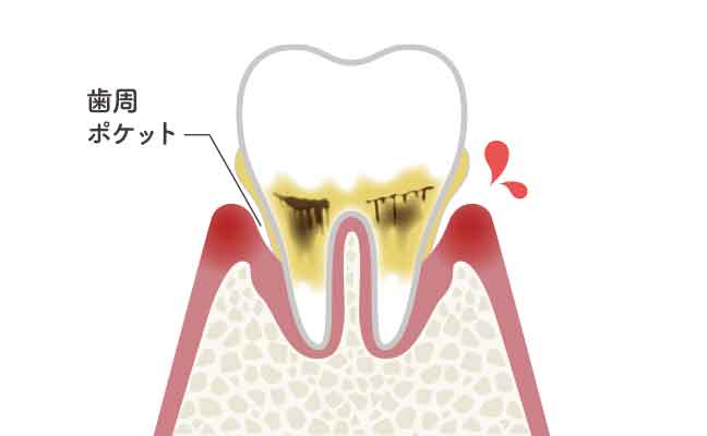 軽度歯周炎
