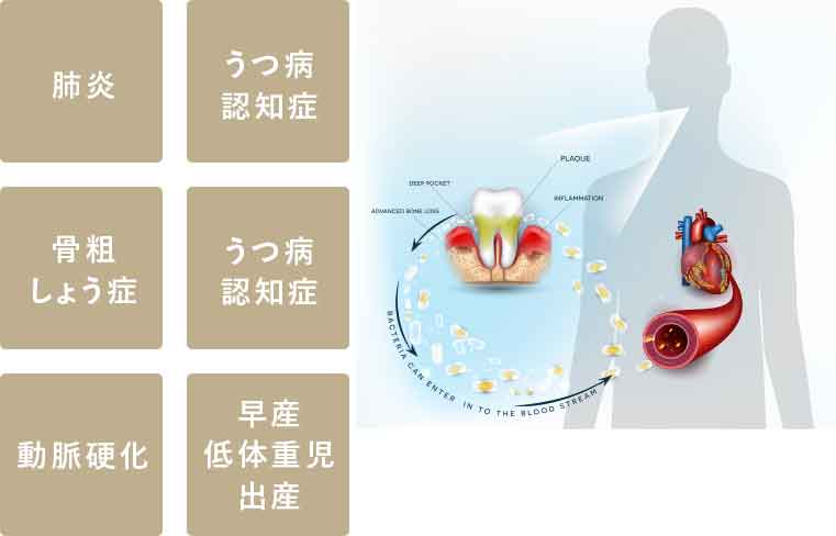 歯周病の進行を抑える歯周病安定期治療SPT