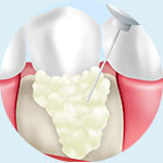 歯周組織再生治療