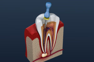 root_canal_01